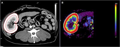 Comparison of Renal Blood Flow Using Maximum Slope-Based Computed Tomography Perfusion and Ultrasound Flow Probe in Healthy Dogs